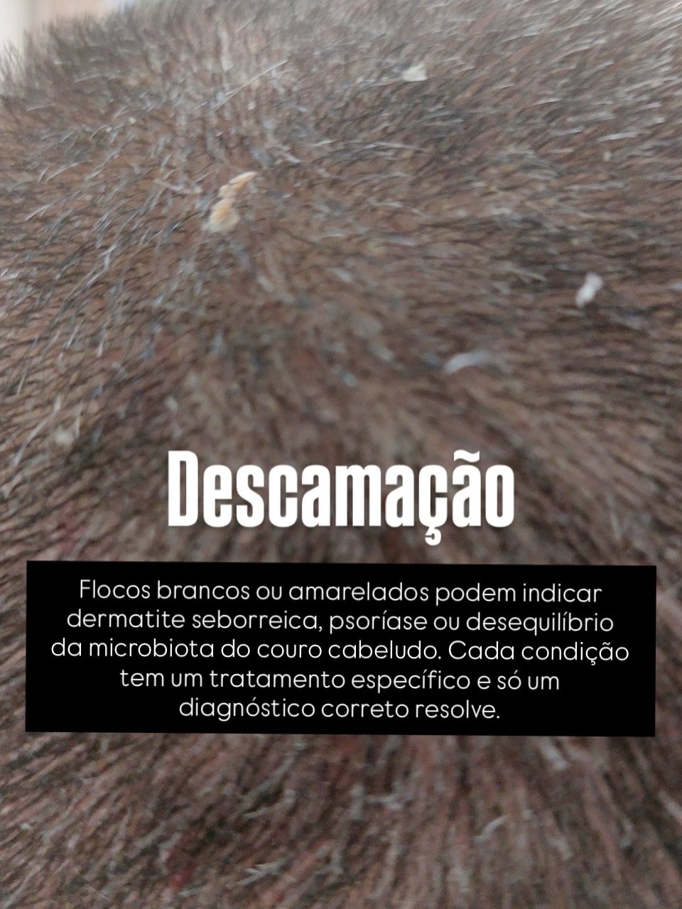 Avaliação capilar com tricoscópio